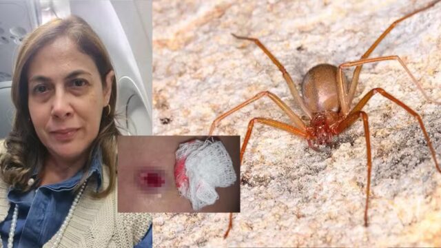 Dentista picada por aranha-marrom relata dor e longo tratamento; mais de 20 mil acidentes em 2025 — Foto: Reprodução/Montagem g1
